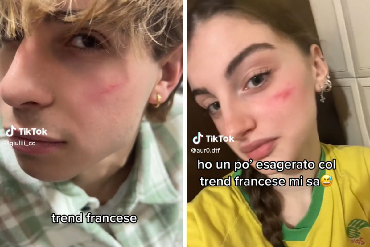 Cicatrice francese, la moda autolesionistica impazza tra i giovani